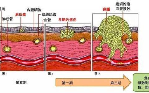 原位癌是什么？原位癌名词解释
